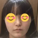 隆鼻術 / 鼻尖形成（切開） / 鼻中隔延長（切開） / 軟骨移植 R Beauty CLINIC 銀座院 DAY 68 サムネイル用