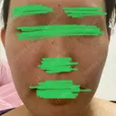 ピーリング（ニキビ・毛穴） MKクリニック 日本橋院 DAY 7 サムネイル用