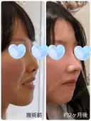 隆鼻術 / 鼻尖形成（切開） / 小鼻縮小（切開） / 軟骨移植 / 鼻柱下降・鼻唇角形成（猫手術） / ボトックス（エラ・小顔） / 毛穴洗浄（ハイドラフェイシャルなど） グローバルビューティークリニック 大阪院 DAY 49 サムネイル用