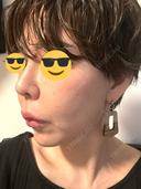 ヒアルロン酸注入（鼻） プリモ麻布十番クリニック DAY 3 サムネイル用