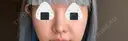 隆鼻術 / 鼻尖形成（切開） / 鼻中隔延長（切開） / 小鼻縮小（切開） / 軟骨移植 R Beauty CLINIC 銀座院 DAY 92 サムネイル用