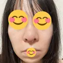 鼻尖形成（切開） / 鼻中隔延長（切開） / 小鼻縮小（切開） / バッカルファット除去 / 脂肪吸引（顔） / 軟骨移植 / 眉間プロテーゼ / 鼻尖縮小 ジョウクリニック 大阪院 DAY 21 サムネイル用