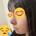 鼻尖形成（切開） / 鼻中隔延長（切開） / 小鼻縮小（切開） / バッカルファット除去 / 脂肪吸引（顔） / 軟骨移植 / 眉間プロテーゼ / 鼻尖縮小 ジョウクリニック 大阪院 DAY 21 サムネイル用