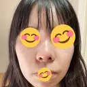 鼻尖形成（切開） / 鼻中隔延長（切開） / 小鼻縮小（切開） / バッカルファット除去 / 脂肪吸引（顔） / 軟骨移植 / 眉間プロテーゼ / 鼻尖縮小 ジョウクリニック 大阪院 AFTER サムネイル用