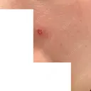ほくろ・いぼ除去レーザー（肌） フェアクリニック川口 DAY 8 サムネイル用