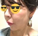 ヒアルロン酸注入（鼻） プリモ麻布十番クリニック DAY 4 サムネイル用