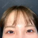 二重埋没 / クマ治療 R Beauty CLINIC 名古屋院 AFTER サムネイル用