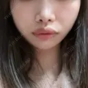 隆鼻術 / 鼻尖形成（切開） / 脂肪吸引（顔） / 軟骨移植 / メーラーファット除去 R Beauty CLINIC 名古屋院 AFTER サムネイル用