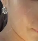 エレクトロポレーション / 光治療（フォトフェイシャルなど） 若倉診療所 AFTER サムネイル用