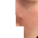 ほくろ・いぼ除去レーザー（肌） フェアクリニック川口 DAY 10 サムネイル用