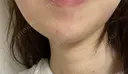 ボトックス（あご） A CLINIC（エークリニック） 新宿院 DAY 6 サムネイル用