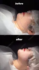 脂肪吸引（顔） ネビュラクリニック 京都院 AFTER サムネイル用