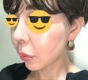 ヒアルロン酸注入（鼻） プリモ麻布十番クリニック DAY 6 サムネイル用