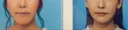 骨切り（あご） / 脂肪吸引（顔） 銀座マイアミ美容外科 AFTER サムネイル用