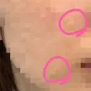 ほくろ・いぼ切除（肌） Jスキンクリニック 【J-SKIN clinic】 DAY 1 サムネイル用