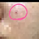 ほくろ・いぼ切除（肌） Jスキンクリニック 【J-SKIN clinic】 DAY 1 サムネイル用