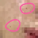 ほくろ・いぼ切除（肌） Jスキンクリニック 【J-SKIN clinic】 DAY 2 サムネイル用