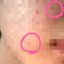 ほくろ・いぼ切除（肌） Jスキンクリニック 【J-SKIN clinic】 DAY 3 サムネイル用