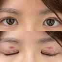 その他（目元） / 自然癒着法 LUHO（ルホ）美容外科 DAY 30 サムネイル用