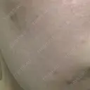 ポテンツァ 渋谷美容外科クリニック 横浜院 DAY 8 サムネイル用