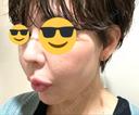 ヒアルロン酸注入（鼻） プリモ麻布十番クリニック DAY 7 サムネイル用