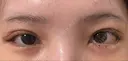 クマ治療 / 目尻切開 / タレ目形成・グラマラスライン（切開） R Beauty CLINIC 銀座院 DAY 6 サムネイル用