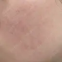 ルメッカ ルラ美容クリニック 福岡本院 DAY 7 サムネイル用