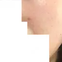 ほくろ・いぼ除去レーザー（肌） フェアクリニック川口 DAY 12 サムネイル用
