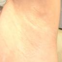 ワキ汗治療（ボトックス） 共立美容外科 名古屋院 AFTER サムネイル用