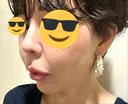 ヒアルロン酸注入（鼻） プリモ麻布十番クリニック DAY 8 サムネイル用