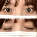 二重埋没 吉祥寺アイビークリニック DAY 4 サムネイル用