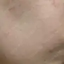 ポテンツァ 渋谷美容外科クリニック 横浜院 DAY 10 サムネイル用