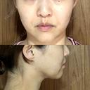脂肪吸引（顔） / 脂肪吸引（脚） / 脂肪吸引（お尻） Mods Clinic（モッズクリニック） 福岡院 DAY 93 サムネイル用