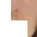 ほくろ・いぼ除去レーザー（肌） フェアクリニック川口 AFTER サムネイル用