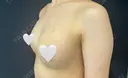 豊胸（脂肪注入） S.T styleクリニック DAY 7 サムネイル用