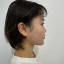 糸リフト / 脂肪吸引（顔） / メーラーファット除去 SEA CLINIC（シークリニック） DAY 127 サムネイル用