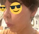 ヒアルロン酸注入（鼻） プリモ麻布十番クリニック AFTER サムネイル用
