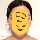 糸リフト / 脂肪吸引注射（顔） 湘南美容クリニック 吉祥寺院 AFTER サムネイル用