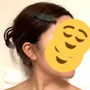 糸リフト / 脂肪吸引注射（顔） 湘南美容クリニック 吉祥寺院 DAY 91 サムネイル用
