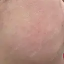 ルメッカ ルラ美容クリニック 福岡本院 DAY 11 サムネイル用
