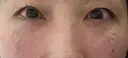 クマ治療 / 脂肪注入（目の下） 湘南美容クリニック 千葉センシティ院 DAY 0 サムネイル用