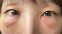 クマ治療 / 脂肪注入（目の下） 湘南美容クリニック 千葉センシティ院 DAY 2 サムネイル用