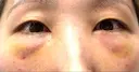 クマ治療 / 脂肪注入（目の下） 湘南美容クリニック 千葉センシティ院 DAY 3 サムネイル用