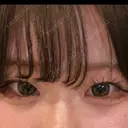 ヒアルロン酸注入（涙袋） ファイヤークリニック 渋谷院 DAY 45 サムネイル用