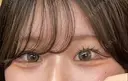 ヒアルロン酸注入（涙袋） ファイヤークリニック 渋谷院 AFTER サムネイル用