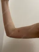 脂肪吸引（二の腕） イテウォンビューティークリニック 名古屋栄院 AFTER サムネイル用