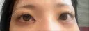 目頭切開 Brandnew Beauty Clinic DAY 0 サムネイル用