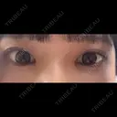 目頭切開 Brandnew Beauty Clinic DAY 6 サムネイル用