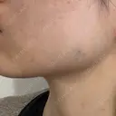 ボトックス（あご） / ボトックス（エラ・小顔） / ハイフ（顔） もとび美容外科クリニック 新宿院 AFTER サムネイル用