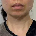 ボトックス（あご） / ボトックス（エラ・小顔） / ハイフ（顔） もとび美容外科クリニック 新宿院 DAY 0 サムネイル用